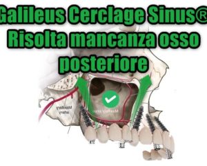 Galileus Cerclage Sinus®