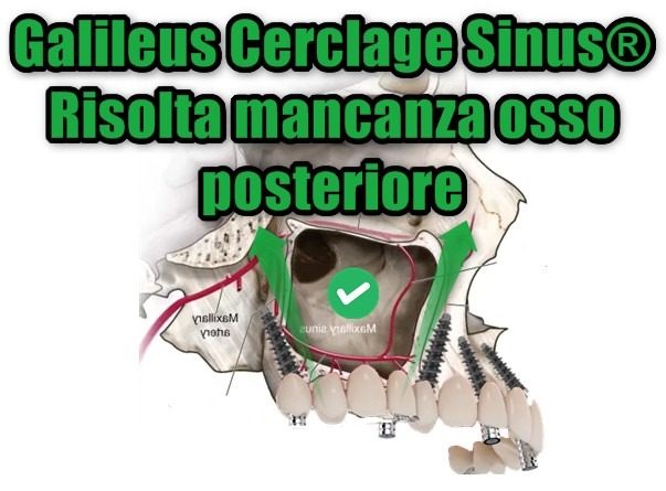 Galileus Cerclage Sinus®